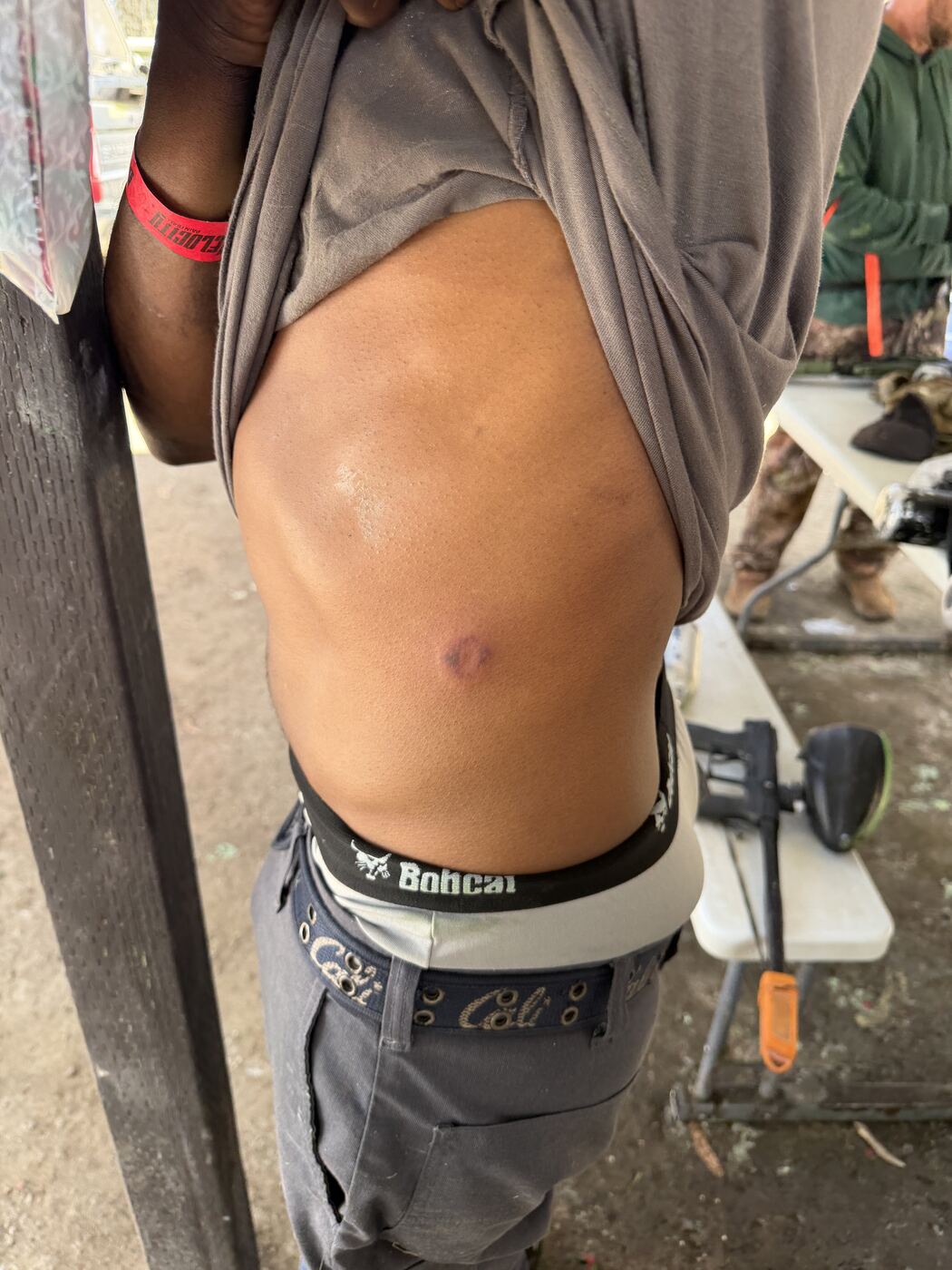 Battle scar — paintball welt earned in the firefight